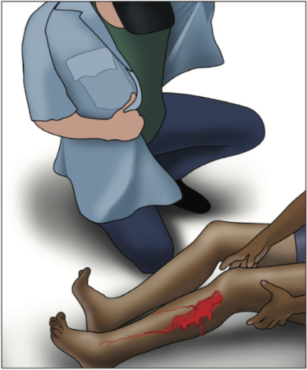 Image depicts a two people; one with a bleeding wound on their leg, and the other taking off a jacket to cover the wound.