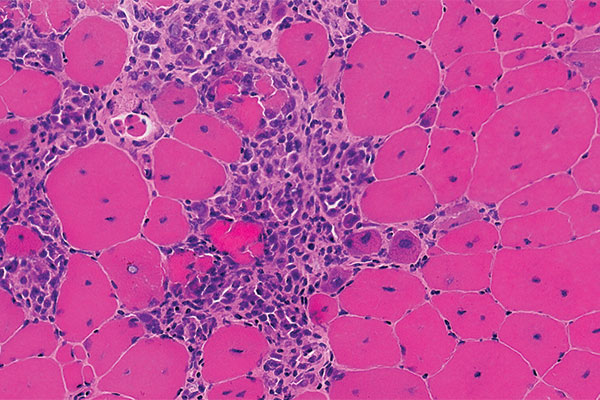 Microscopic view of dystrophin-deficient muscle tissue with inflammatory cells. Duchenne is the most common hereditary neuromuscular disease and does not exhibit a predilection for any race or ethnic group. Mutations in the dystrophin gene lead to progressive muscle fiber degeneration and weakness.